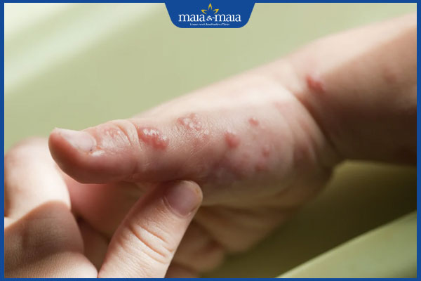 Zona ở trẻ em có nguy hiểm không? Khi nào cần gặp bác sĩ? 2 tình trạng zona ở trẻ