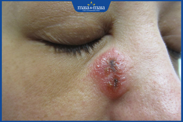 tình trạng zona thần kinh ở mũi