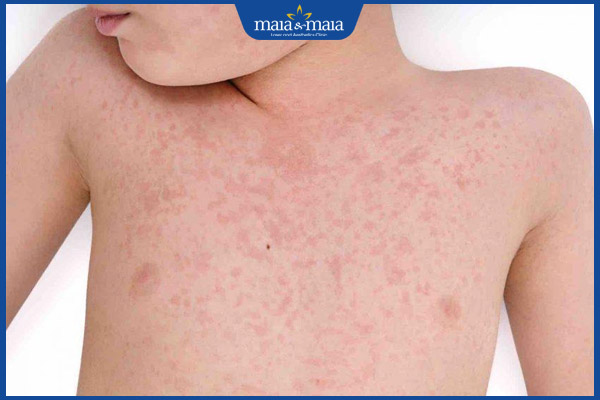 Dị ứng ở trẻ do đâu? Cách xử lý và phòng ngừa an toàn cho bé 2 trẻ nổi ban đỏ khắp người