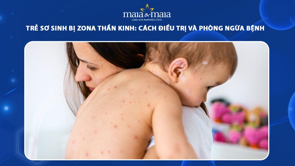 trẻ sơ sinh bị zona thần kinh