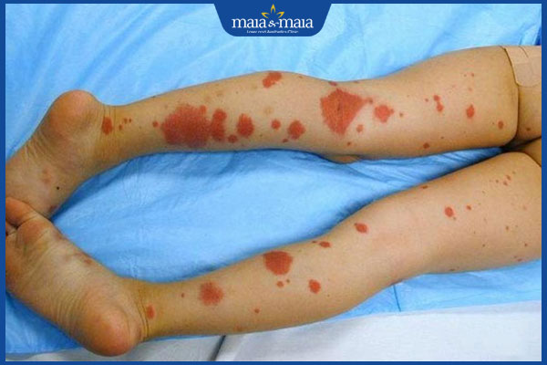 Viêm mao mạch dị ứng là gì? Dấu hiệu và cách điều trị 5 trẻ viêm mao mạch dị ứng