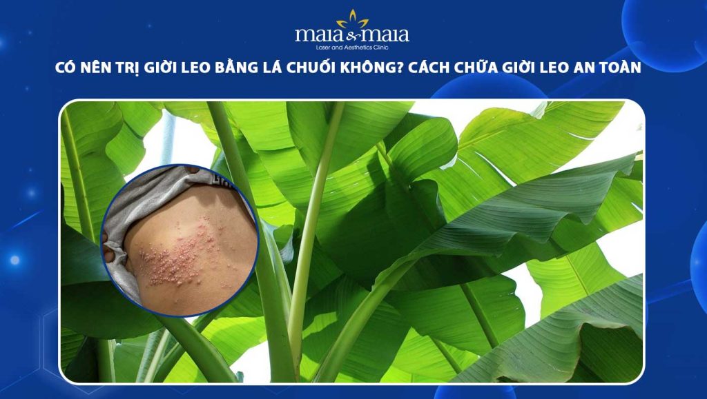 trị giời leo bằng lá chuối
