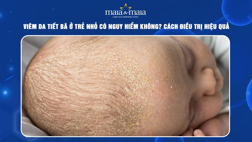 Viêm da tiết bã ở trẻ