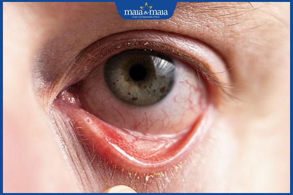 viêm kết mạc dị ứng