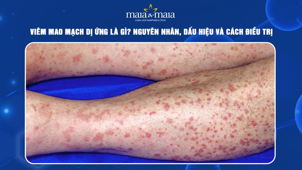 Viêm mao mạch dị ứng