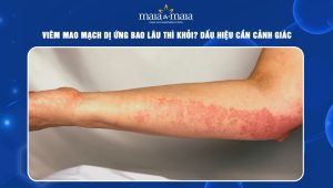 Viêm mao mạch dị ứng bao lâu thì khỏi