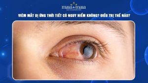 Viêm mắt dị ứng thời tiết