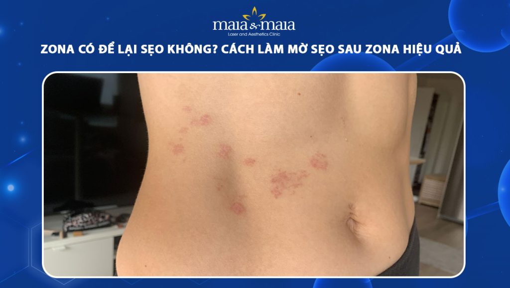 zona có để lại sẹo không