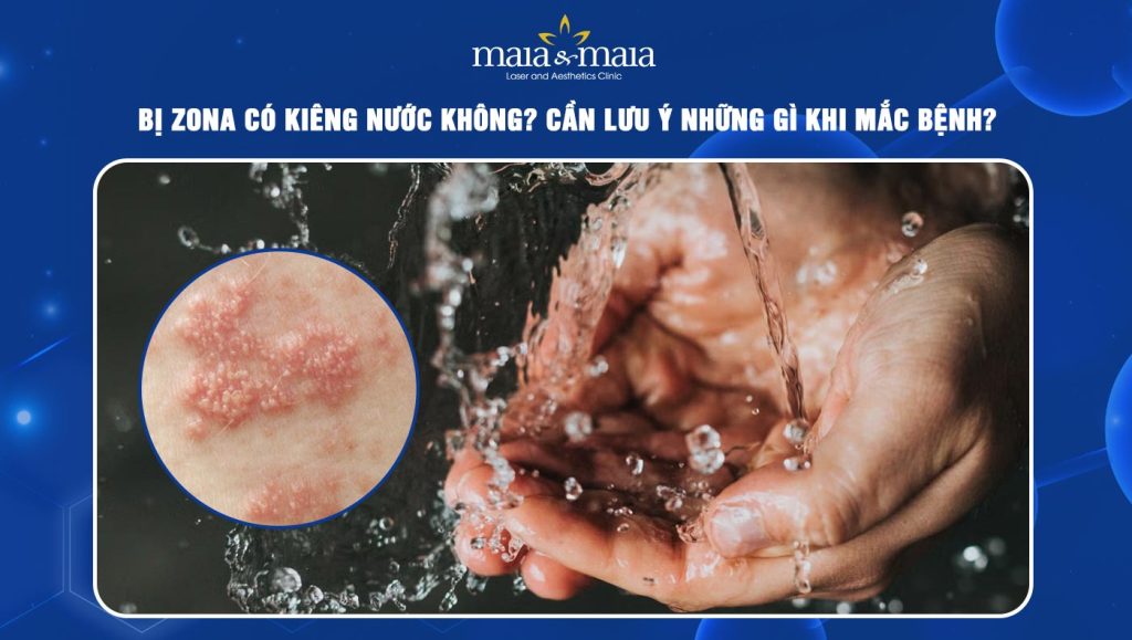 zona có kiêng nước không