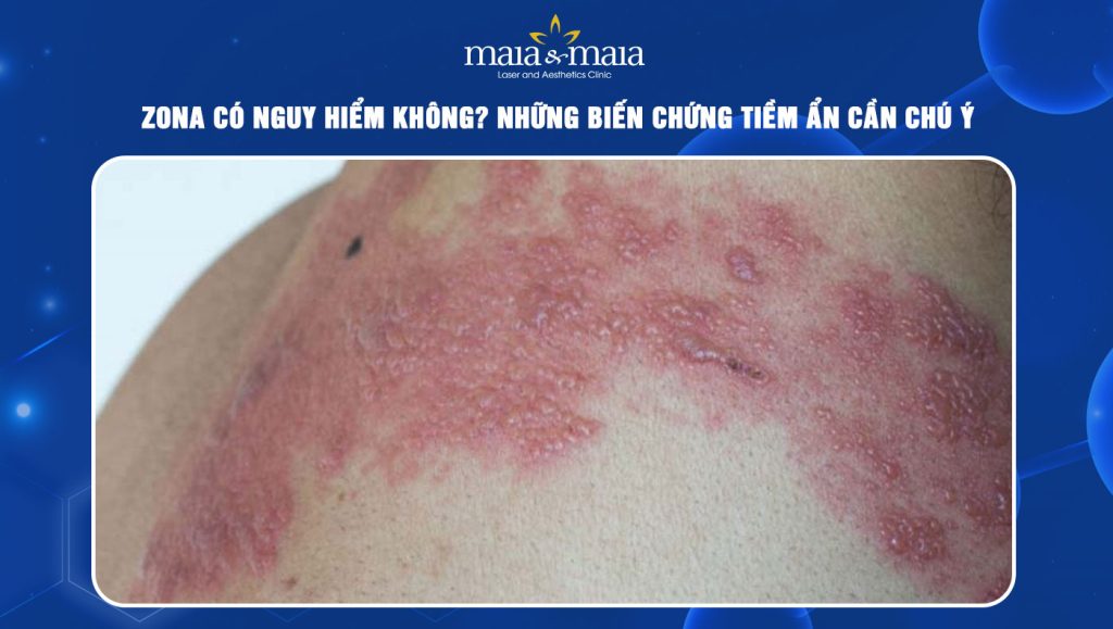 Zona có nguy hiểm không? Biến chứng tiềm ẩn cần chú ý 1 Zona có nguy hiểm không