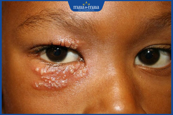 Zona thần kinh ở mắt: Chẩn đoán và điều trị bệnh hiệu quả 4 zona mắt mụn nước