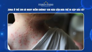 zona ở trẻ em có nguy hiểm