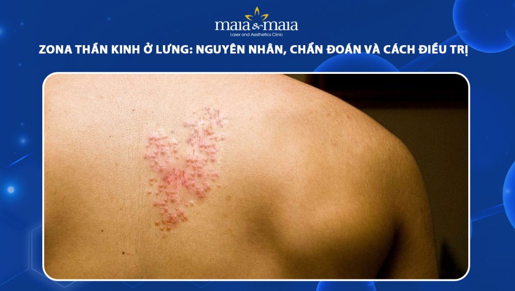 zona thần kinh ở lưng