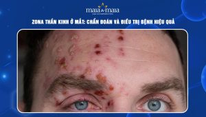 zona thần kinh ở mắt