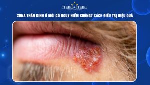 Zona thần kinh ở môi