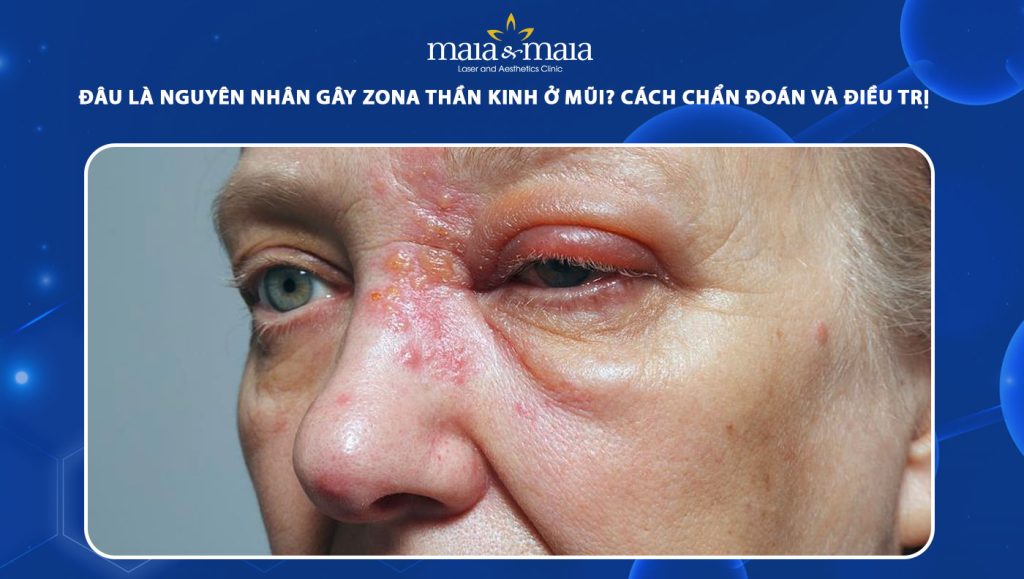 zona thần kinh ở mũi