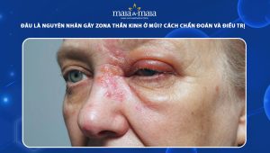 zona thần kinh ở mũi