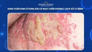 zona thần kinh ở vùng kín