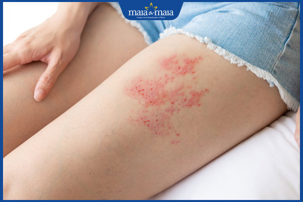 zona xuất hiện ở đùi