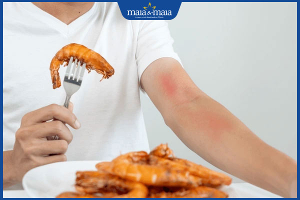 ăn hải sản bị dị ứng