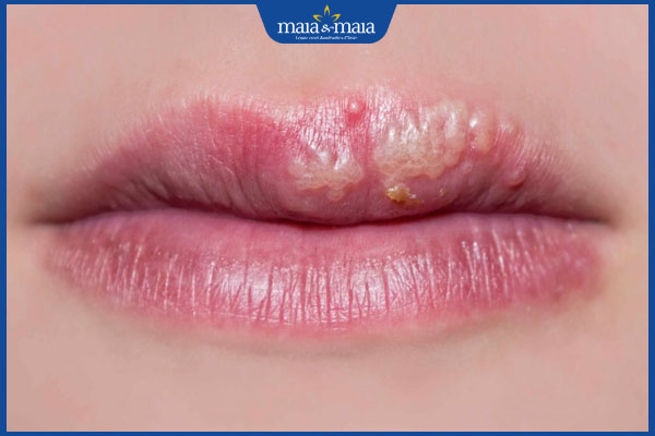 bi dị ứng mực xăm