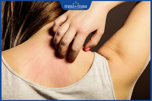 bị dị ứng sau sinh