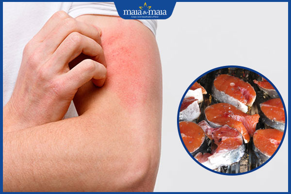 bị dị ứng với cá