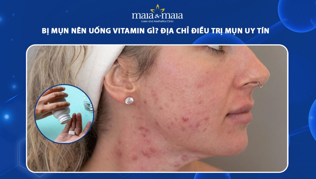 Bị mụn nên uống vitamin gì để cải thiện và đảm bảo an toàn? 1 bị mụn nên uống vitamin gì