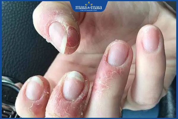 bị viêm da quanh móng