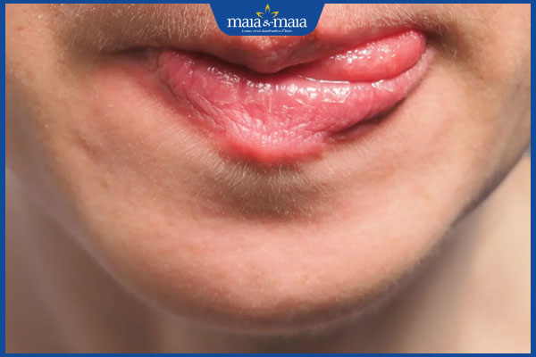 Viêm mép môi là gì? Triệu chứng, nguyên nhân & cách điều trị 5 bị viêm mép môi