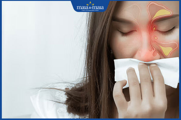 bị viêm xoang