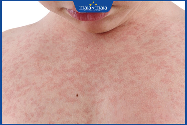 Ai dễ bị dị ứng thuốc kháng sinh? Cách nhận biết và xử lý 5 biểu hiện dị ứng kháng sinh