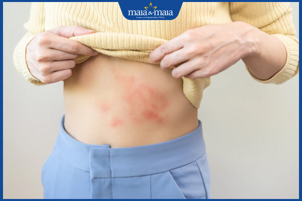 biểu hiện dị ứng nước giặt