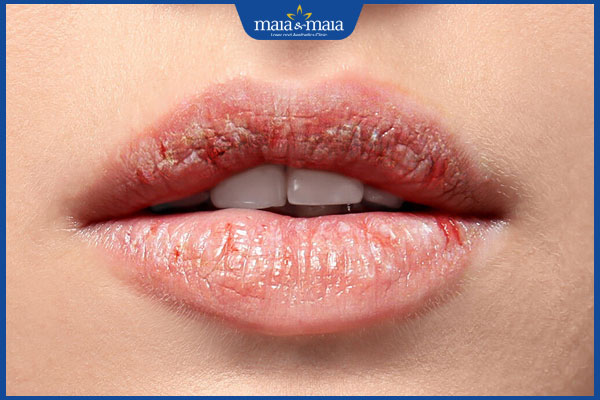 Dị ứng son môi là như thế nào? Cách xử lý khi gặp phải 2 biểu hiện dị ứng son môi