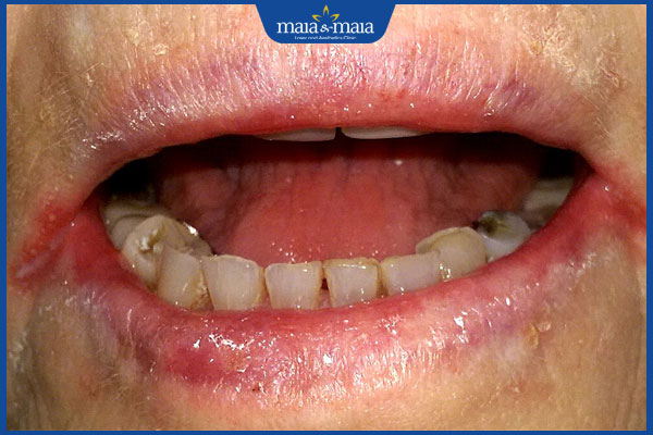 biểu hiện viêm môi dị ứng