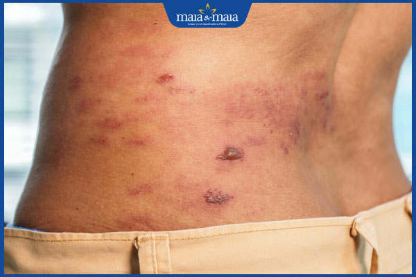 biểu hiện zona lan tỏa