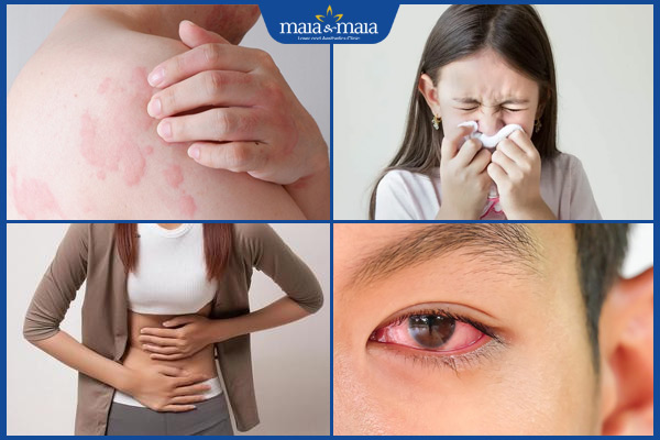 các dấu hiệu dị ứng