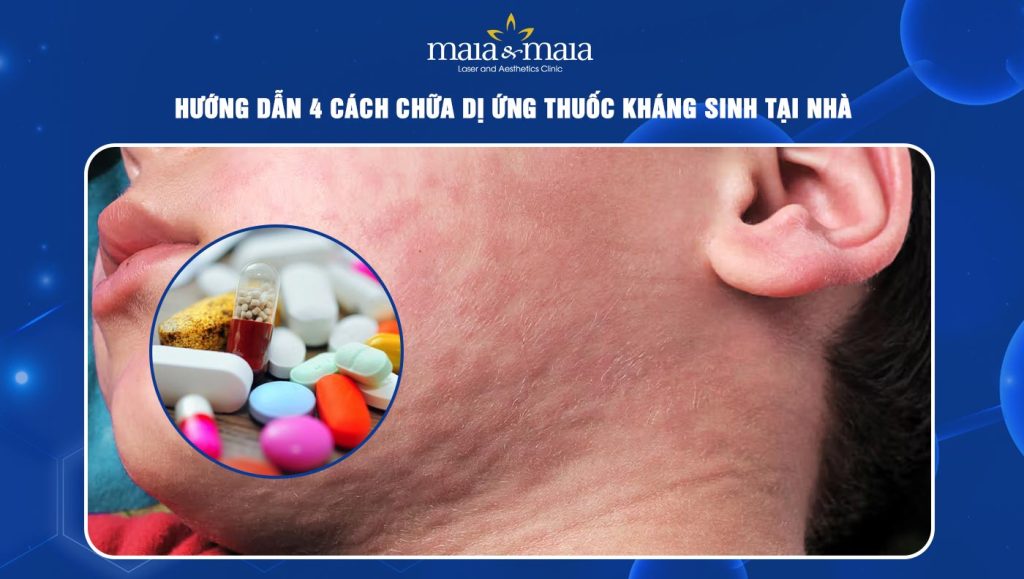 cách chữa dị ứng thuốc kháng sinh