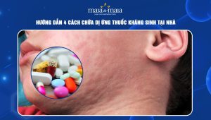 cách chữa dị ứng thuốc kháng sinh