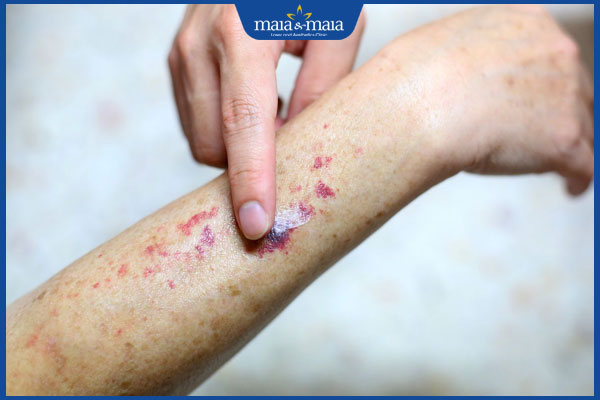 chăm sóc viêm mao mạch dị ứng