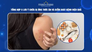 chữa dị ứng thức ăn