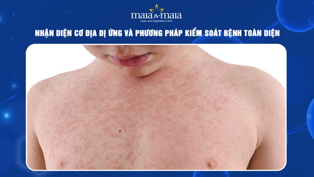 cơ địa dị ứng