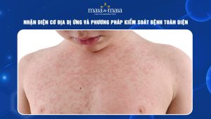 cơ địa dị ứng