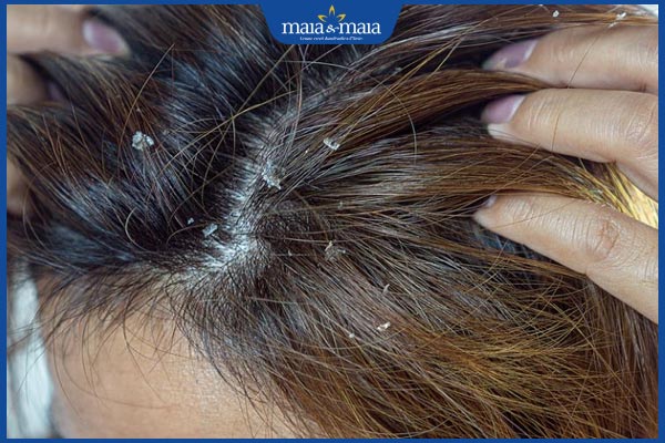 da đầu ngứa gàu