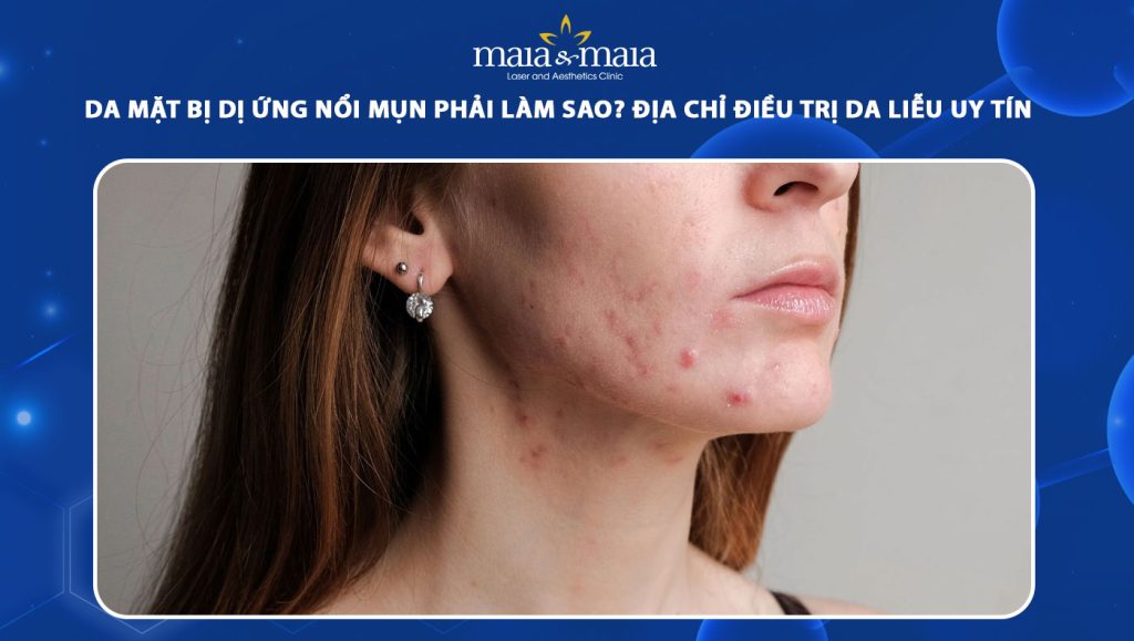 Da mặt bị dị ứng nổi mụn làm thế nào? Địa chỉ da liễu uy tín 1 da mặt bị dị ứng nổi mụn