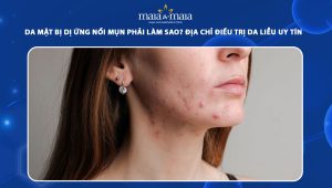 da mặt bị dị ứng nổi mụn