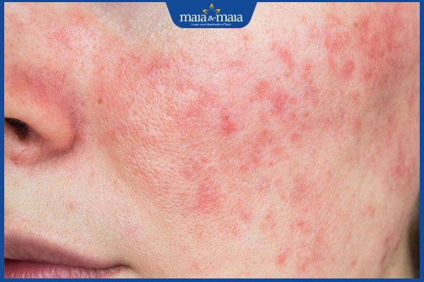 da mặt nhạy cảm