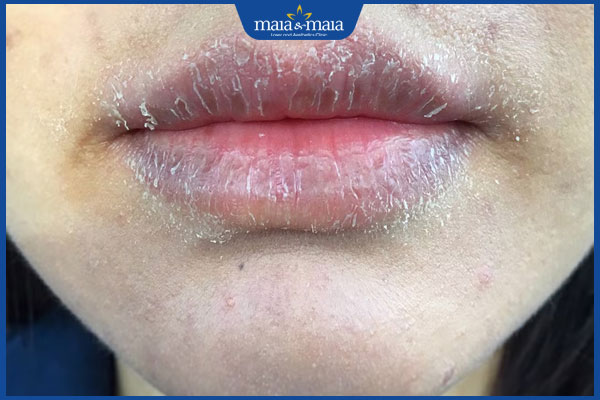 da môi khô bong tróc