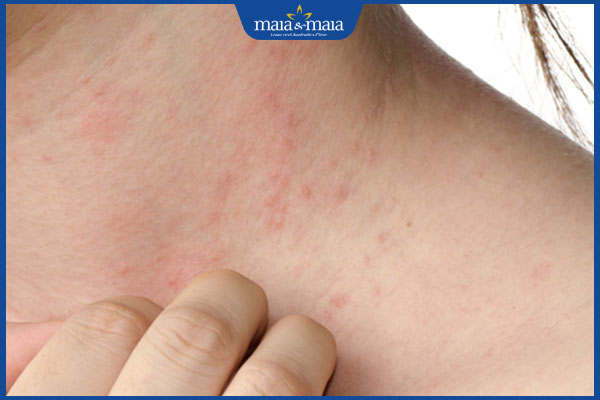 da nổi mẩn đỏ