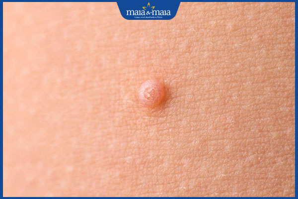 da nổi nốt sần